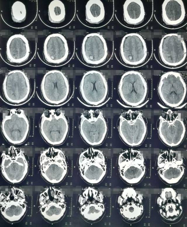 脑组织肿胀图片