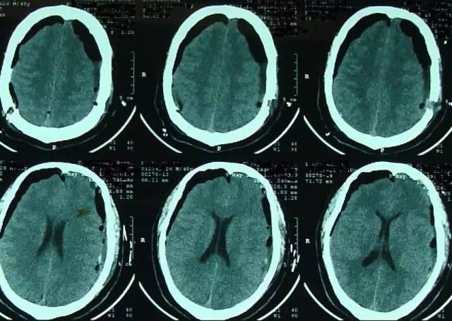 2017年5月7日上海某醫院頭顱ct提示:顱腦術後,雙側額顳頂部硬膜下積液