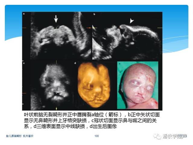 胎儿口角裂四维图片图片