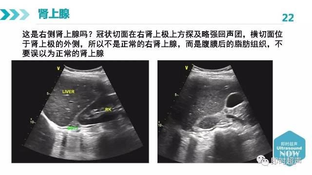 肾上腺正常解剖及疾病超声诊断