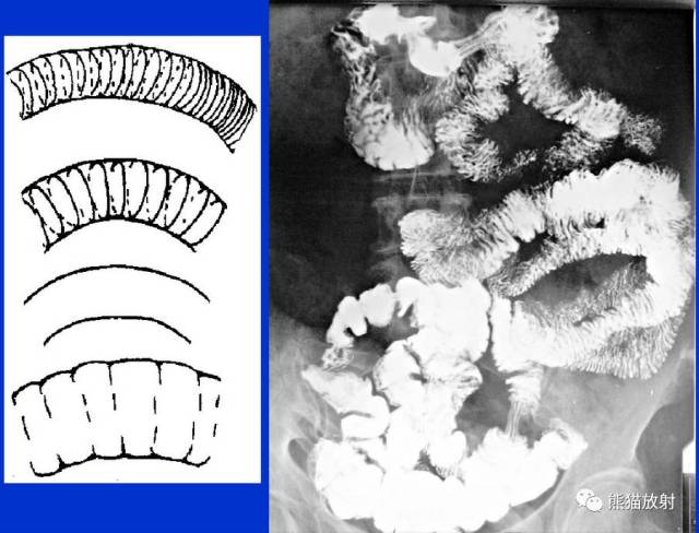 显著,呈羽毛状;回肠粘膜皱襞不明显,多呈环状;回肠末段常显示纵行皱襞