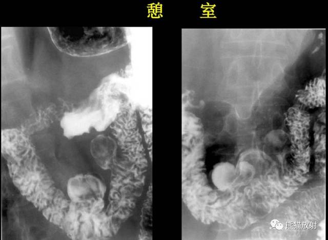 ⑥ 运动力的改变:表现为运动力增速(包括激惹征象),排空加快及运动力
