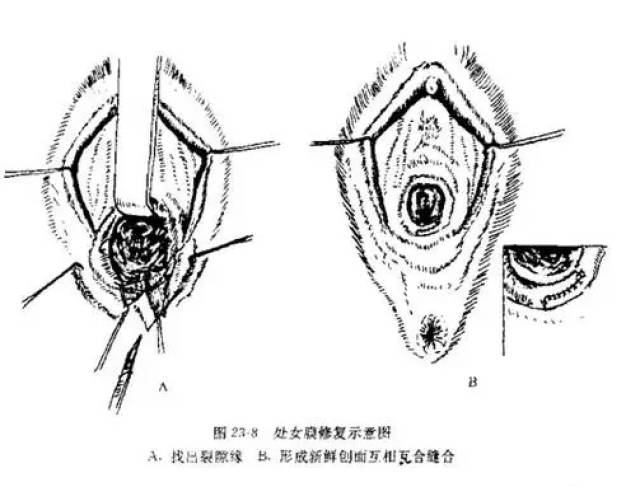 有的较宽,修复手术就是通过外科手术,将已经破裂的处女膜重新缝合还原
