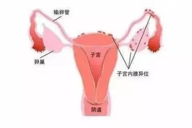 子宫内膜异位症,经常被描述为"盆腔的沙尘暴",因为涉及的病变范围较广