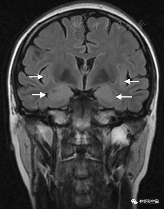 抗神经元细胞内抗原抗体相关自身免疫性脑炎临床分析