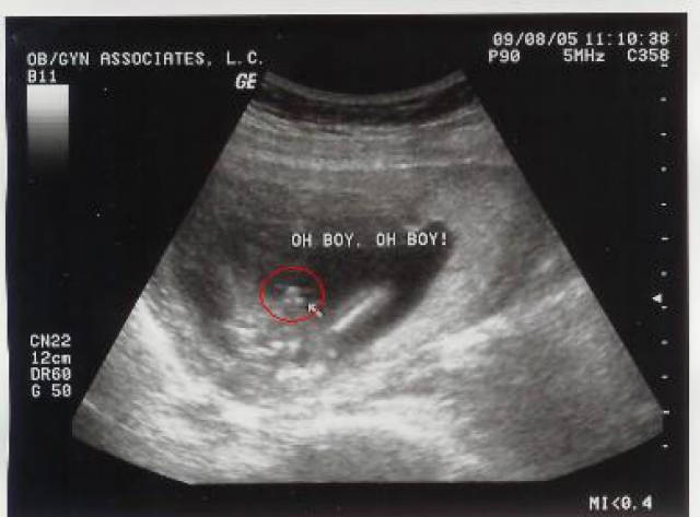 怀男孩孕囊图片 男宝图片