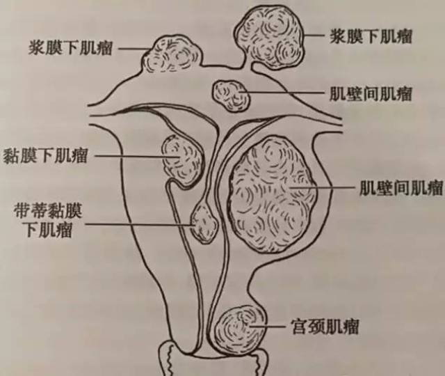 子宫肌瘤什么情况下需要考虑手术_手机搜狐网