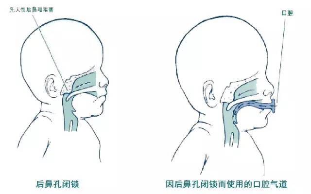 先天性后鼻孔闭锁图片图片