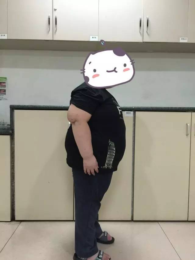 那个患天使综合征的小胖墩,缩胃减肥后现在怎么样了?