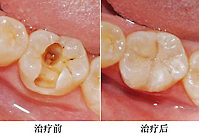 補牙算在醫保範圍嗎 補牙算進醫保嗎