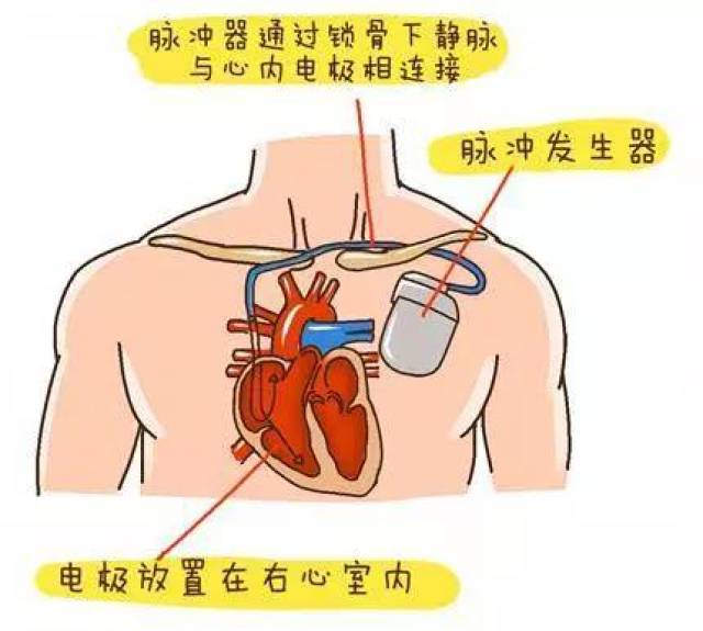 它像一个人工的心脏司令部,代替心脏的起搏点,维持心脏的正常跳动