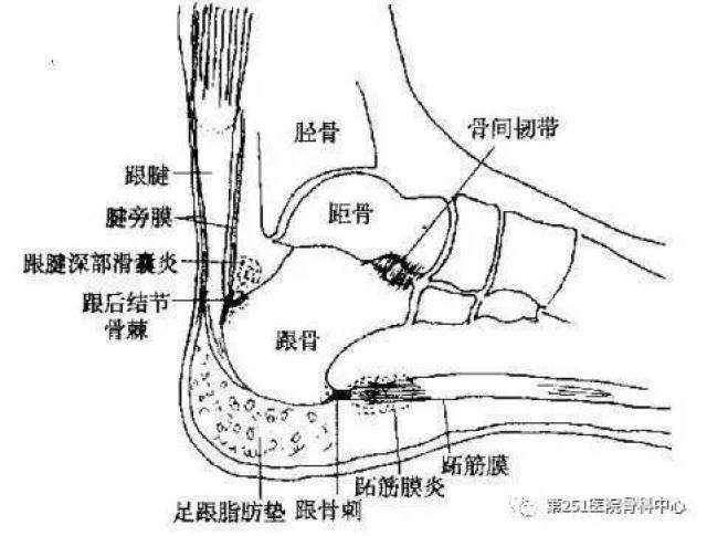 想判断跟腱炎和腱围炎