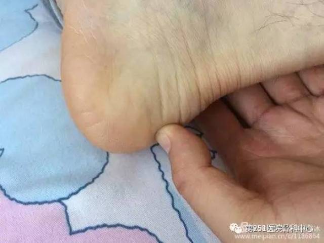 跟腱末端病图片