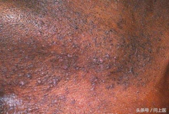 私密部位长的这些小东西,你知道都是什么吗?