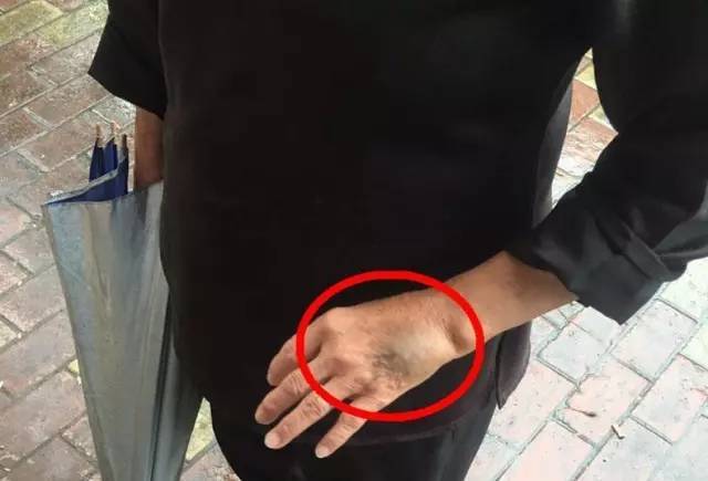 手都被打淤青了