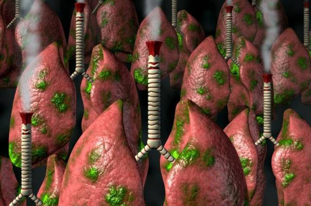 一染上肺癌,身上必出现4类症状,是医生考试的标准答案