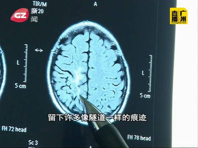 25厘米长寄生虫在12岁女孩脑中"挖隧道"!只因为喝了
