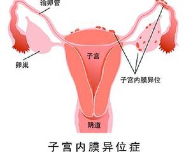 子宫内膜异位症——是指有活性的内膜细胞种植在子宫内膜以外的位置而