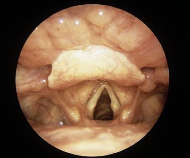 或過度使用聲帶受傷;其他原因還包括過敏,抽菸,慢性胃酸逆流侵蝕食道