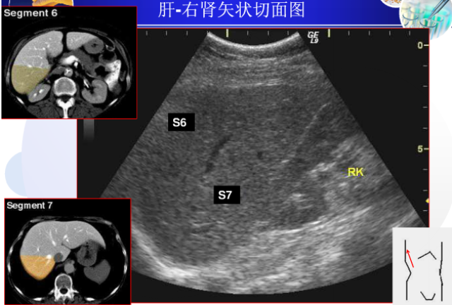 【超声微课堂】肝脏超声分段