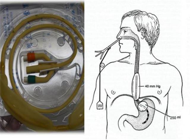 三腔二囊管止血部位图片