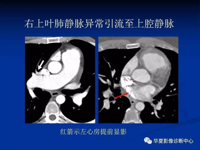 【影像基础】肺静脉畸形引流影像学诊断