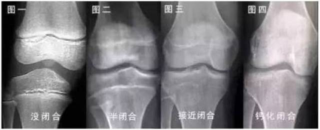 骨骺线闭合示意图