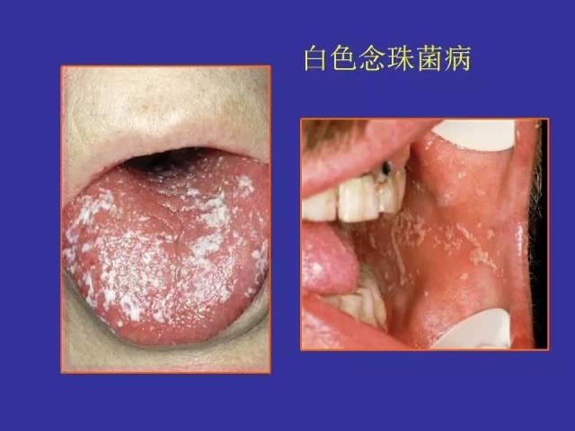 多图连载(二):口腔黏膜感染性疾病及溃疡类疾病图示