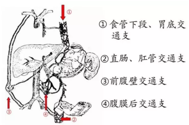 门静脉高压图解图片