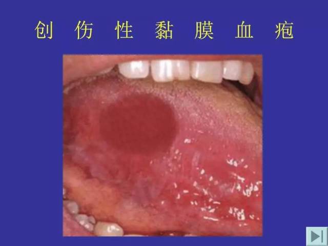 6)轉歸:大多數口腔黏膜病預後良好,但有些口腔癌前病變有癌變風險.