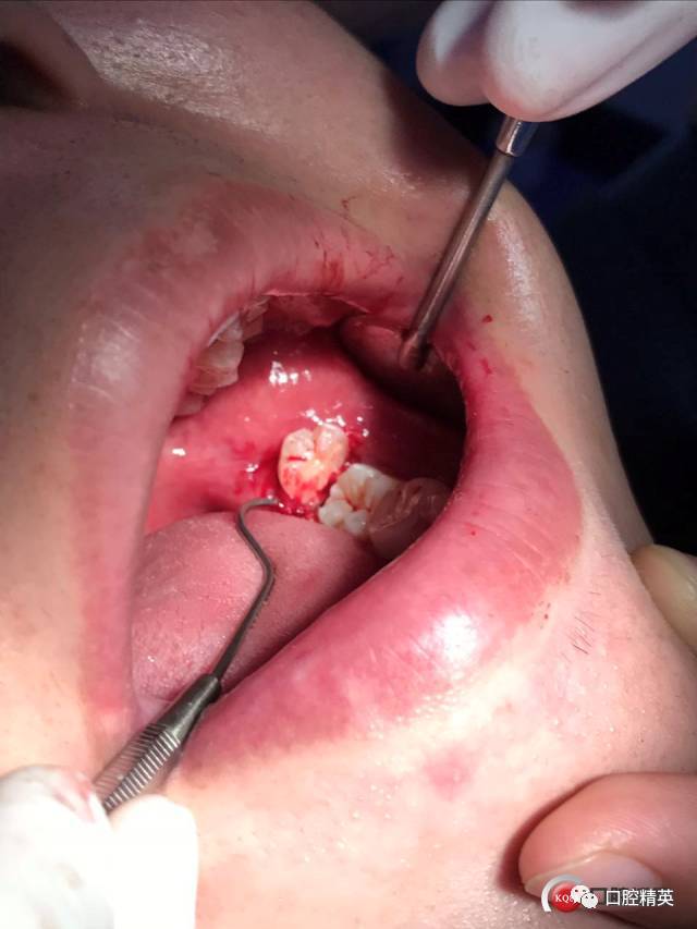 微创拔除下颌阻生牙1例