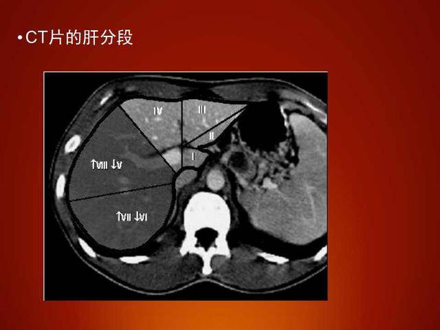 肝左叶工字形结构图片