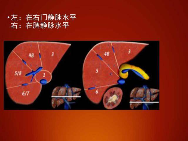 肝左叶工字形结构图片