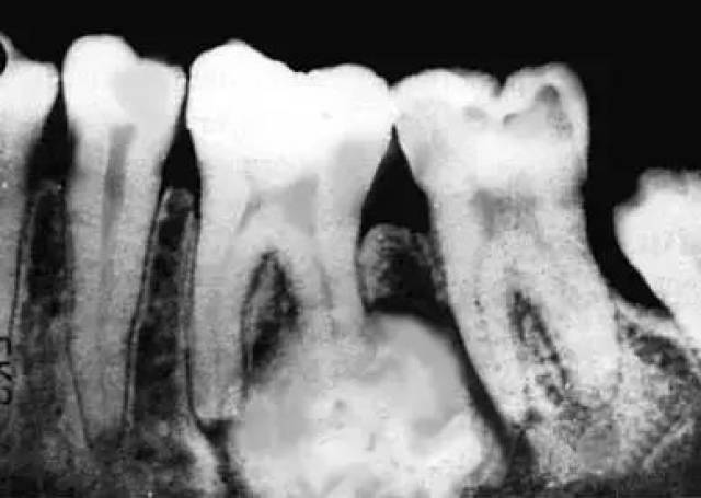 巨大牙骨质瘤图片图片