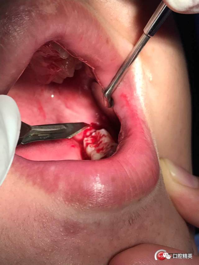 冠周龈瓣切除术图片