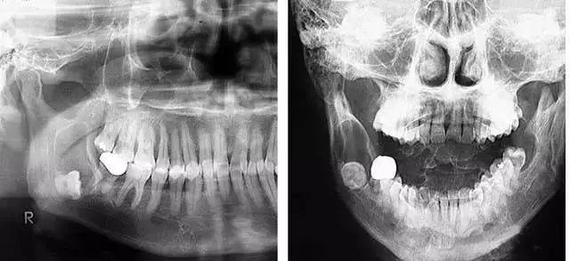 含牙囊肿影像学图片