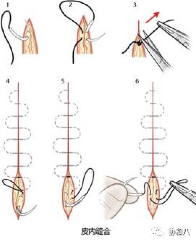 外科8种缝合方法图解图片