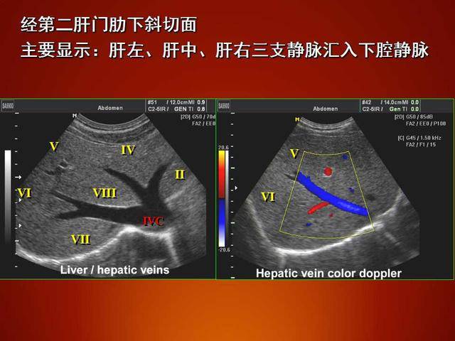 门静脉工字型图片