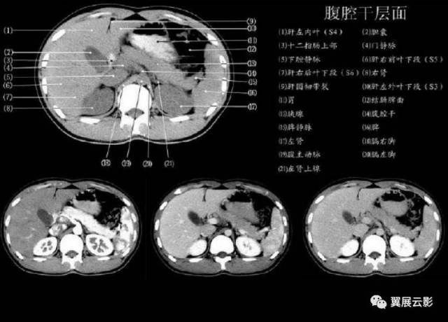 ct肝脏分叶分段解剖图图片