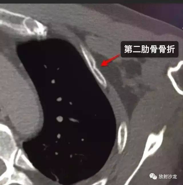 肋骨ct断层图解图片