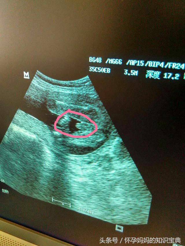 彩超三个月男胎儿图片图片