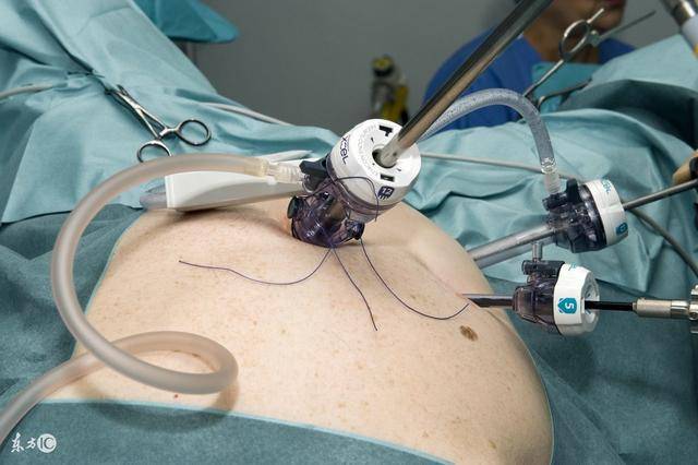 合理布孔,精确定位肿瘤,制定恰当切线,选择性血流阻断,精细的肝实质离