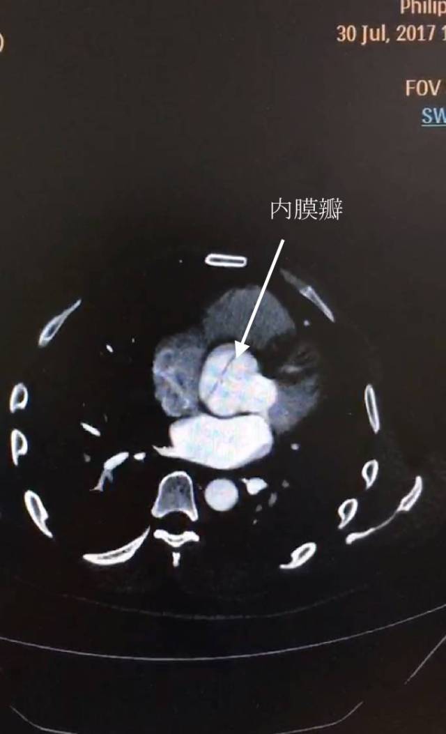 cta确诊为 stanford a型主动脉夹层.