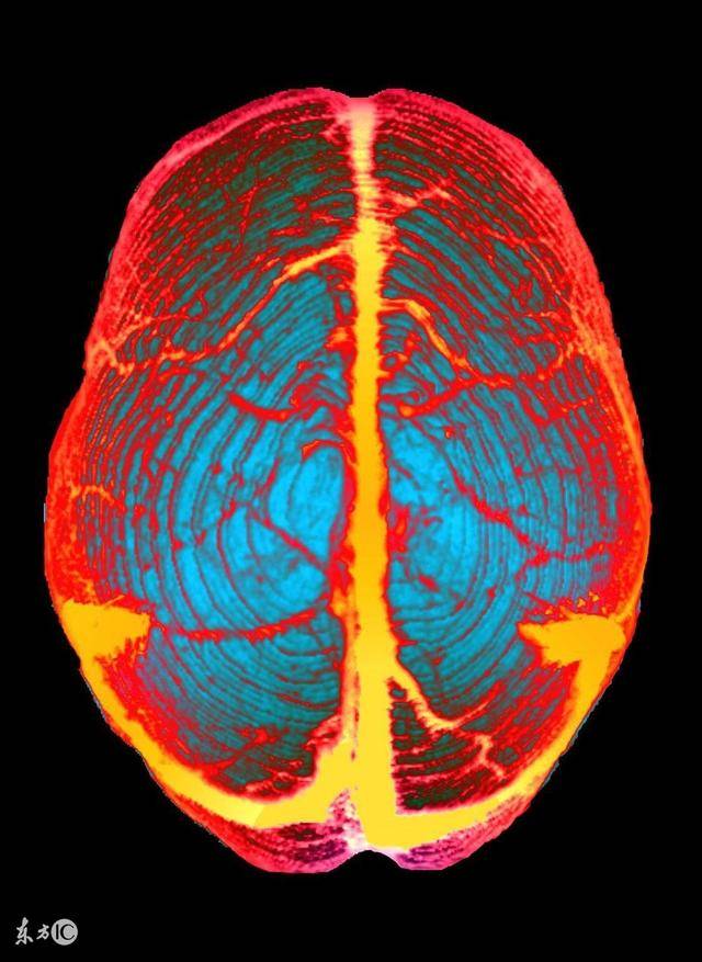 头颅静脉解剖图mrv图片