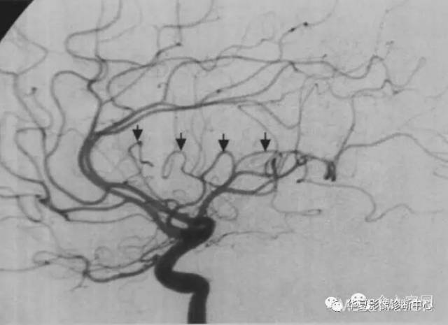 大腦中動脈分段詳解（簡圖+DSA+實體解剖）_大腦中動脈分段解剖圖DSA - 菲歐網