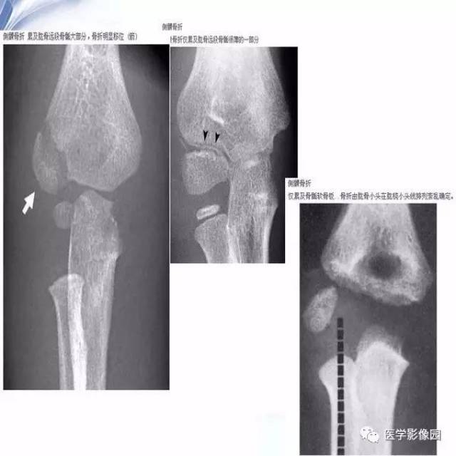 兒童肘關節骨折的x線診斷丨影像天地