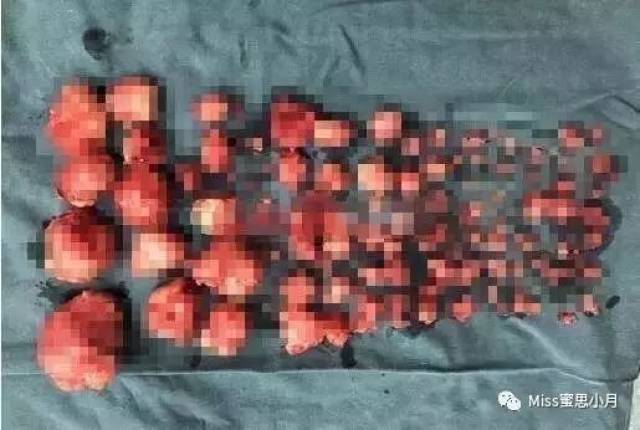 29岁女子子宫里长110颗肌瘤,竟是因为