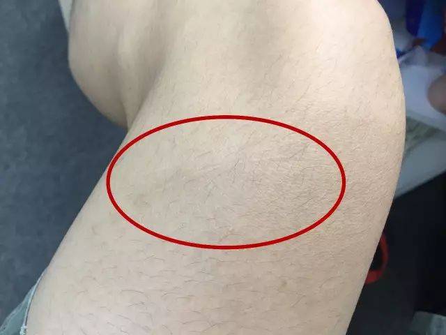 狗咬的疤痕图片
