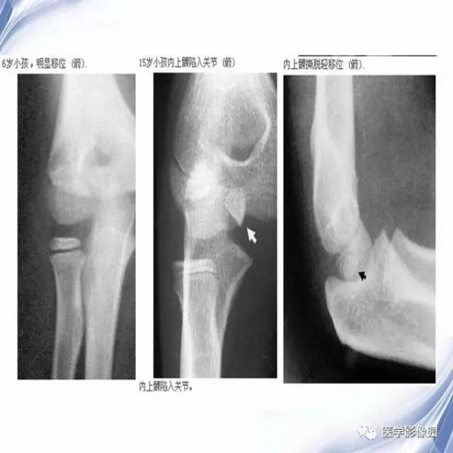 儿童肘关节骨折的x线诊断丨影像天地