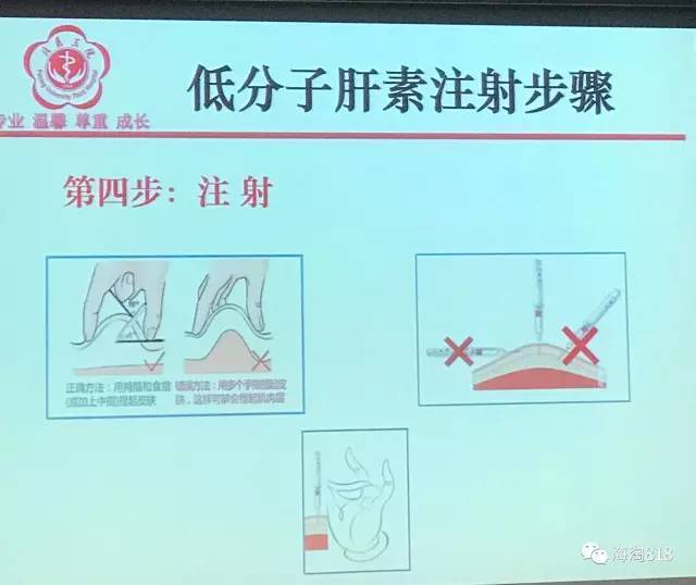 低分子肝素自我注射的技巧及观察